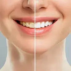 icone-clareamento-dental